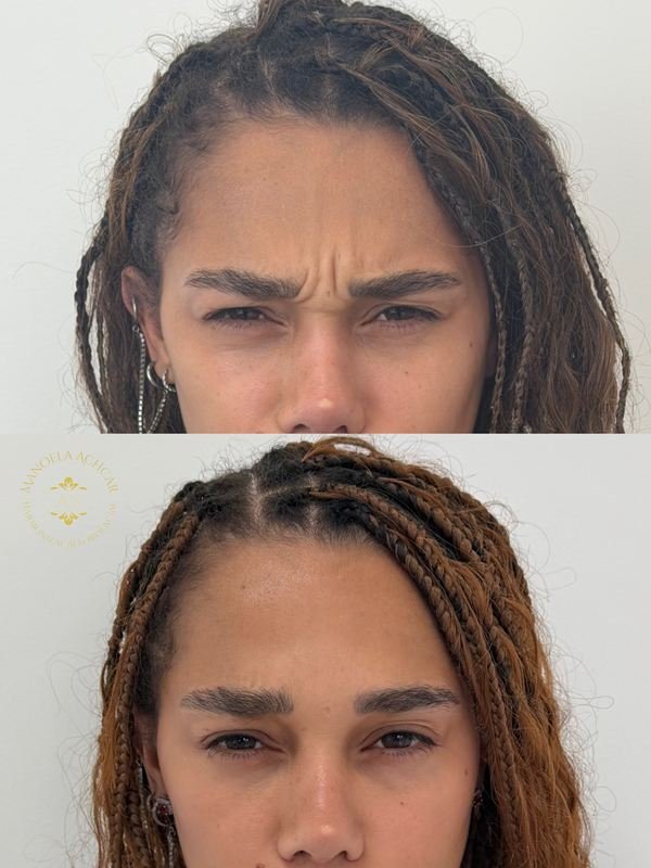 Antes e depois de Botox, caso 2