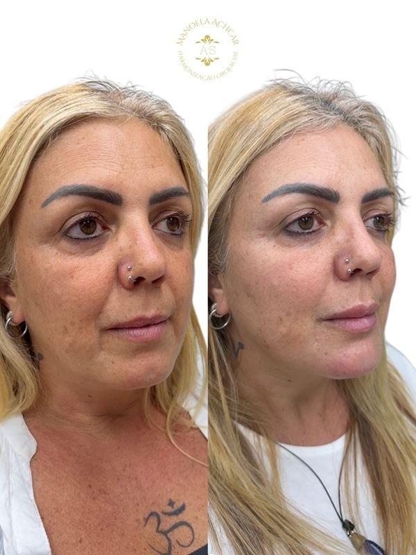Antes e depois de Full Face, caso 2