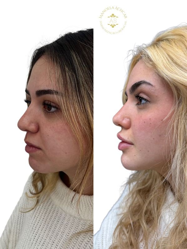 Antes e depois de Perfiloplastia, caso 2